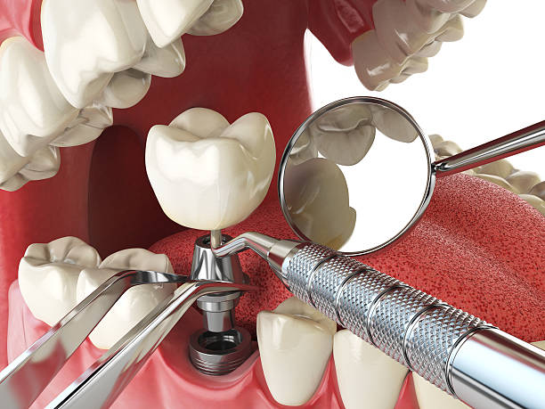 Best Emergency Dentist for Lost Fillings or Crowns in Buffalo, WY